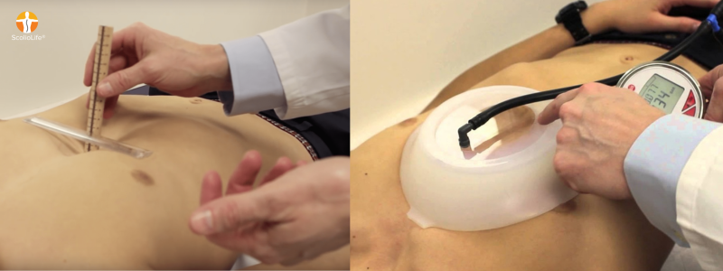 Vacuum Bell 健康補助具　バキュームベル　ソルブ社　漏斗胸 漏斗胸のバキュームベル療法：本当に効果はある？
